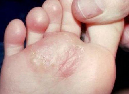 Itchy White Bumps On Foot - Doctor insights on HealthTap